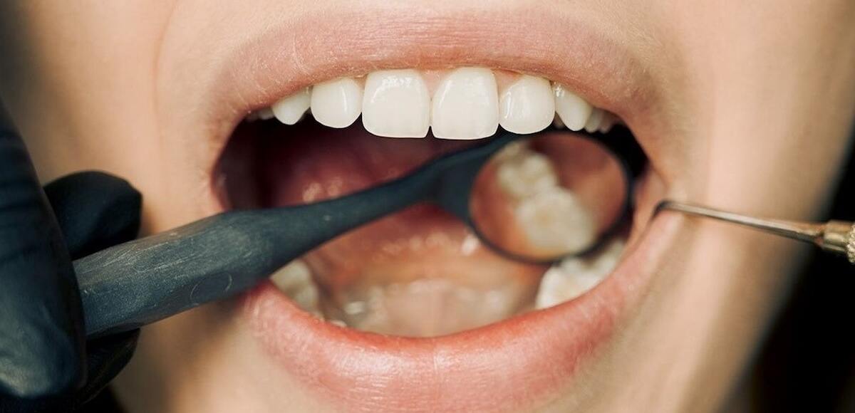 denti gialli come sbiancarli