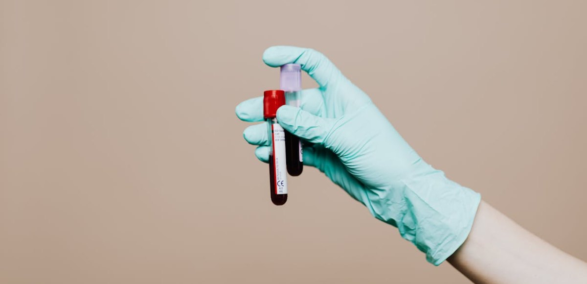 Anticorpi anti-dna nativo