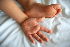 come si presenta la malattia mani piedi bocca