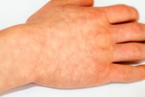 Eritema alla mano