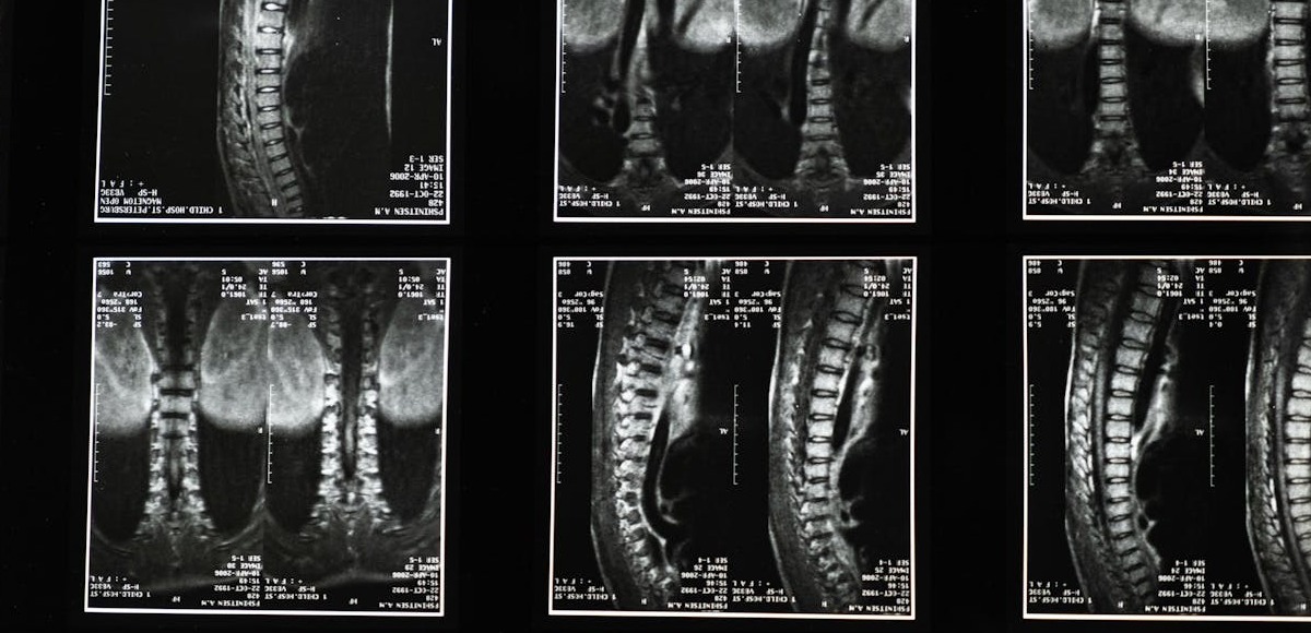 L’osteopenia è una riduzione della densità minerale ossea che determina una riduzione della massa ossea, con conseguente fragilità.