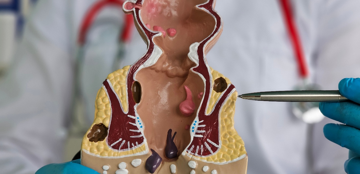 quali farmaci per emorroidi