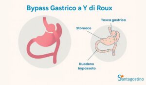 bypass-gastrico-y-roux