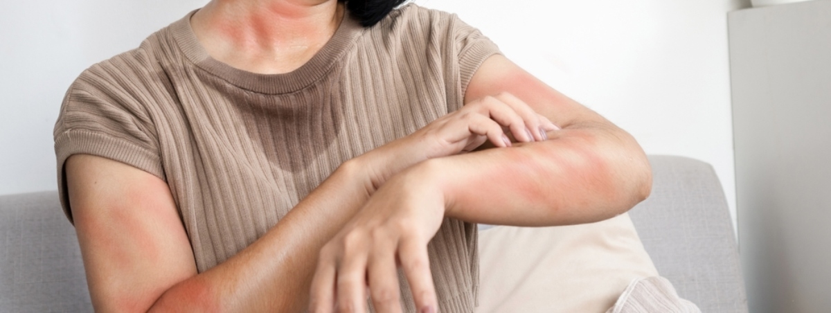 orticaria colinergica