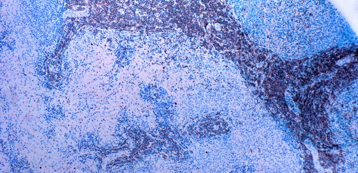 tipizzazione linfocitaria